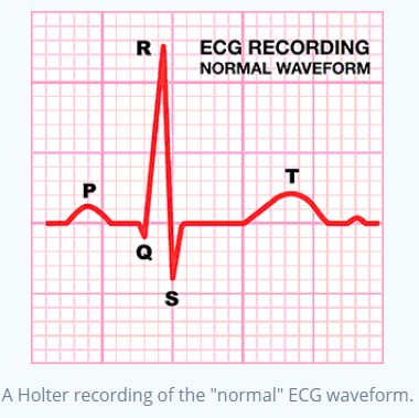 ECG Waveform
